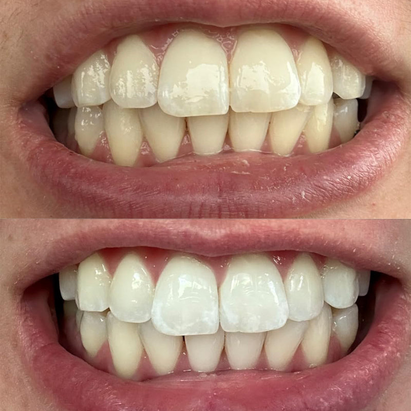 💧Smileasego™ Bělicí remineralizační zubní prášek, bez fluoridu, leštidlo na zuby a odstraňovač skvrn