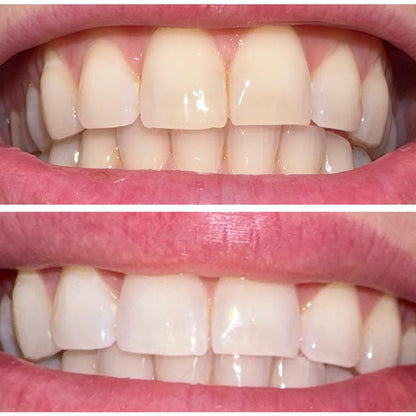 💧Smileasego™ Bělicí remineralizační zubní prášek, bez fluoridu, leštidlo na zuby a odstraňovač skvrn